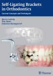 Self-Ligating Brackets in Orthodontics 2012