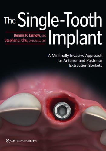 The Single-Tooth Implant 2020