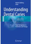 Understanding Dental Caries 2016
