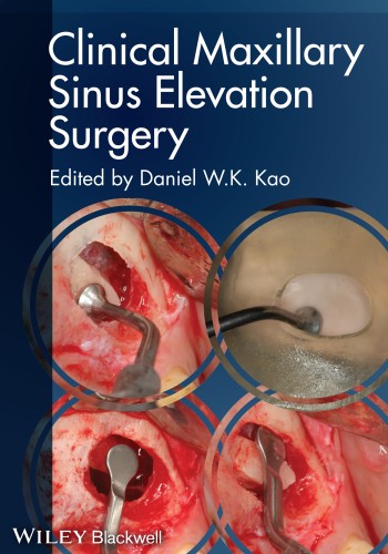Clinical Maxillary Sinus Elevation Surgery 2014