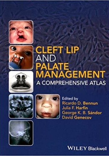 Cleft Lip and Palate Management2016 