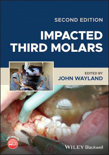 Impacted Third Molars 2023