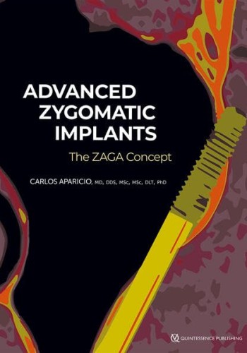 Advanced Zygomatic Implants: The Zaga Concept 2023
