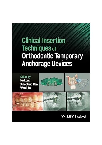 Clinical Insertion Techniques of Orthodontic Temporary Anchorage Devices 2024