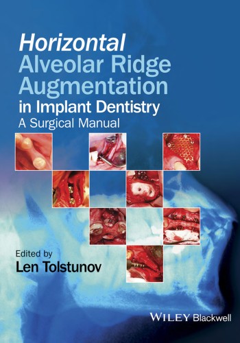 Horizontal Alveolar Ridge Augmentation in Implant Dentistry 2016