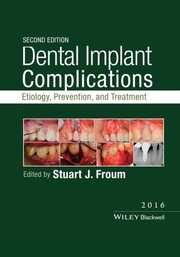 Dental Implant Complications 2016