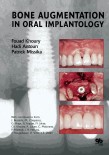 Bone Augmentation In Oral Implantology