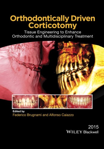 Orthodontically Driven Corticotomy 2015