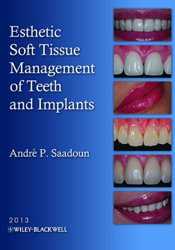 Esthetic Soft Tissue Management of Teeth and Implants2013
