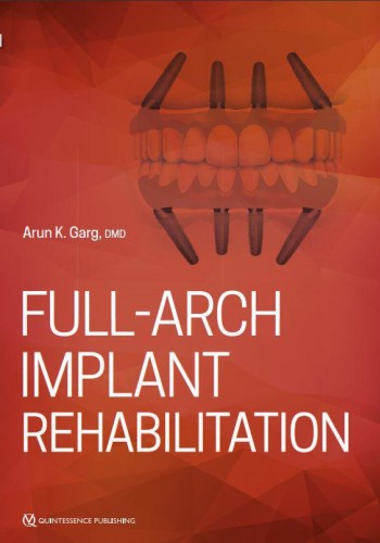 Full-Arch Implant Rehabilitation2019