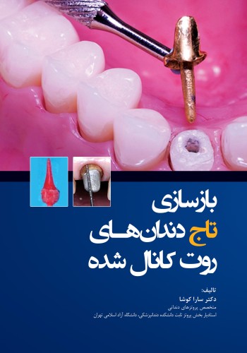 بازسازی تاج دندان های روت کانال شده